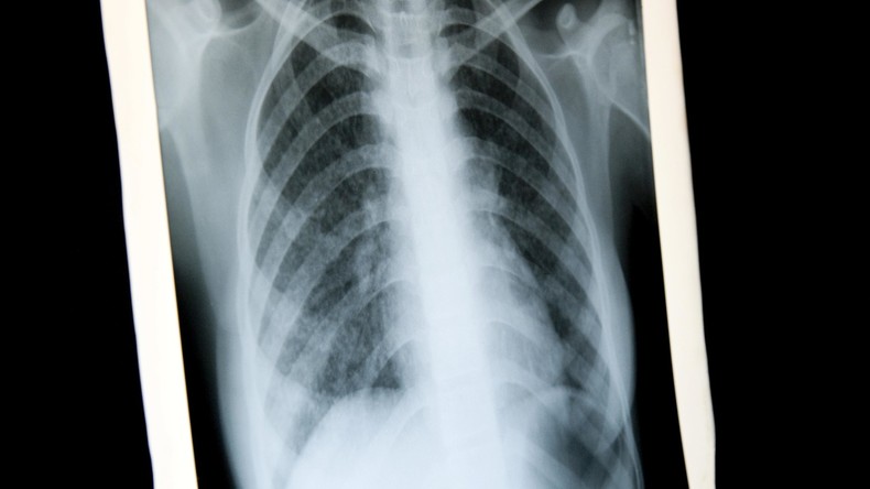 Tuberkulose-Fall an Klinik Würzburg: 200 Patienten werden untersucht
