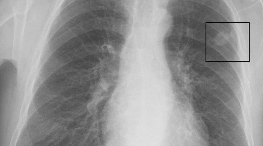 Cancer deaths drop 23%, but it is now top killer in much of US