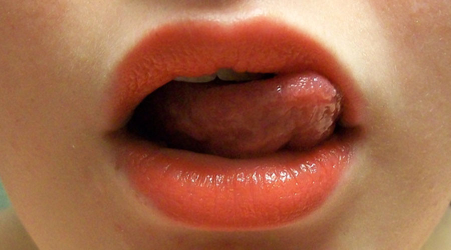 Artificial tongue could help oral cancer sufferers speak again