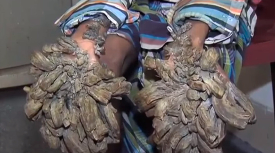 ‘Treeman’ receives surgery for huge, bark-like tumors (VIDEO)