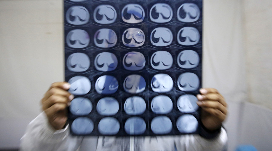 Cancer preventable: Healthy habits can reduce deaths, study finds
