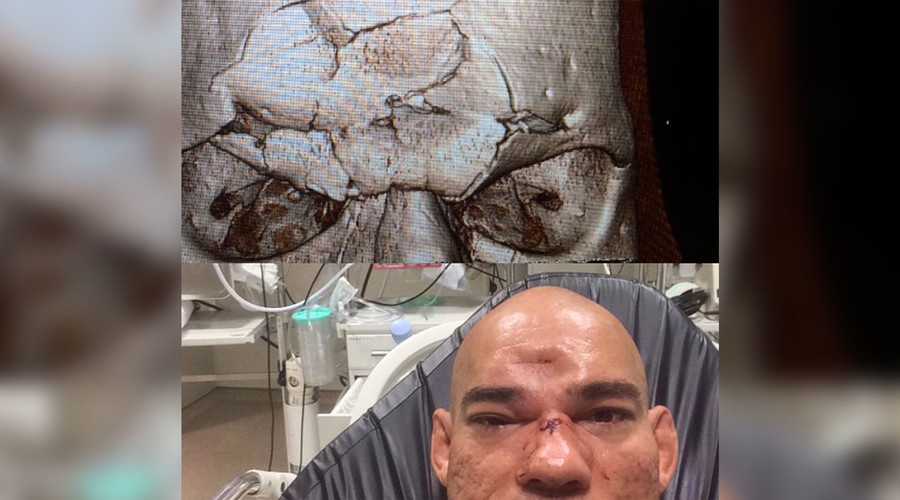 Santos suffers horrifying injury after a knee to head hit from Michael Page