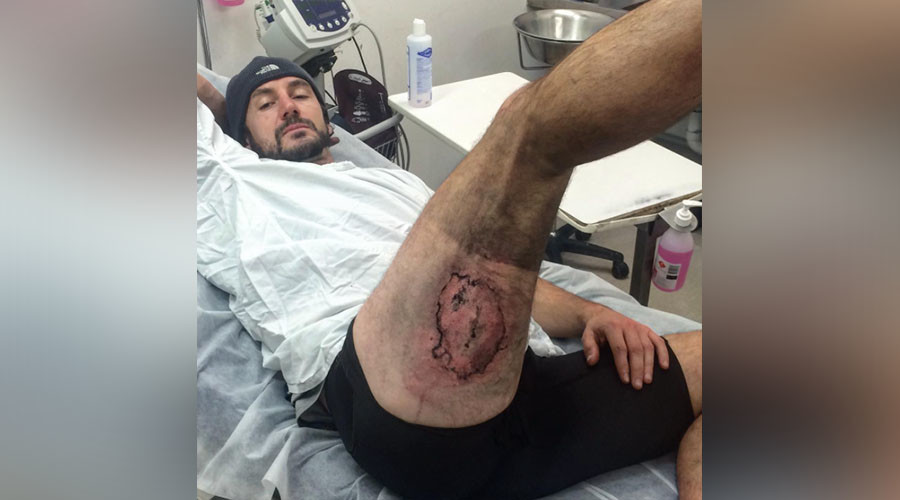 Burner phone: iPhone explodes on cyclist’s leg after fall (PHOTOS)