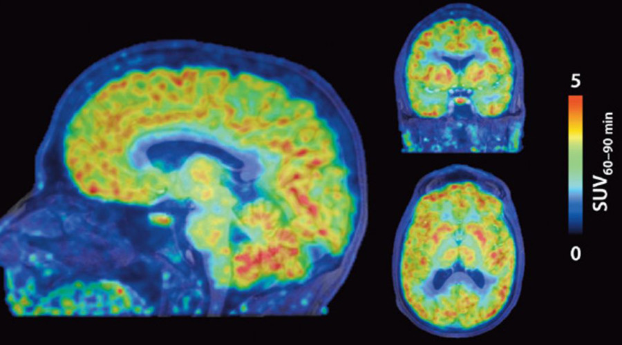 Gene activity in living human brains captured for first time in potential Alzheimer’s breakthrough