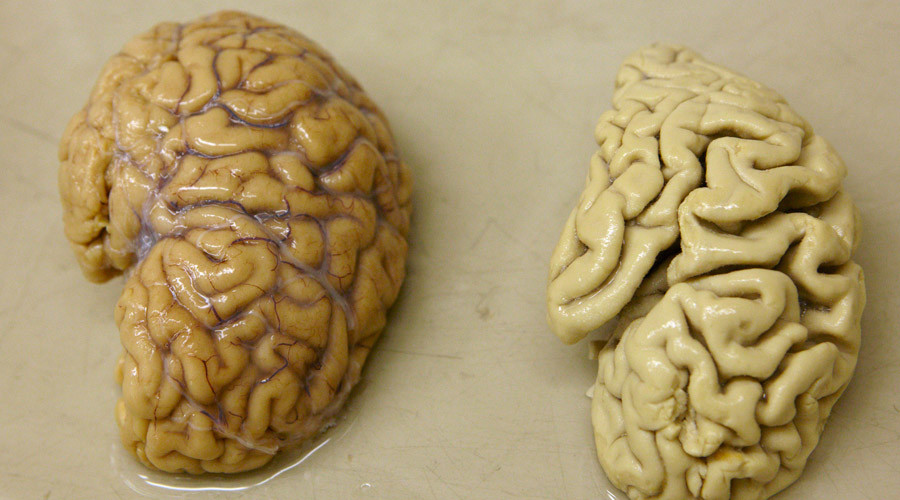 Scientists may have ‘game changer’ drug to treat Alzheimer’s