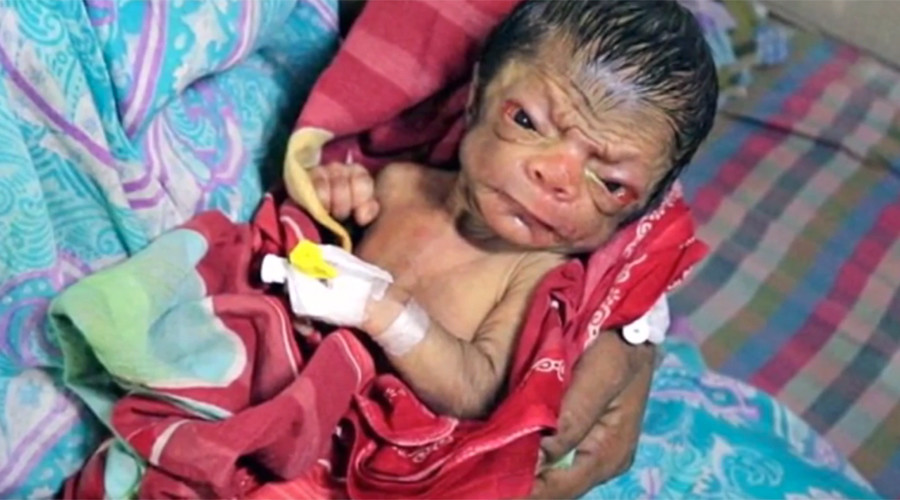 Baby born as ‘old man’ in case of ‘real life Benjamin Button’ (PHOTOS)