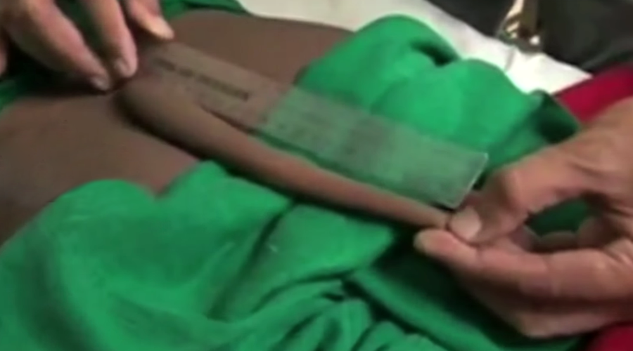 Human tail gets the chop: Teenager has 7-inch growth removed (VIDEO)