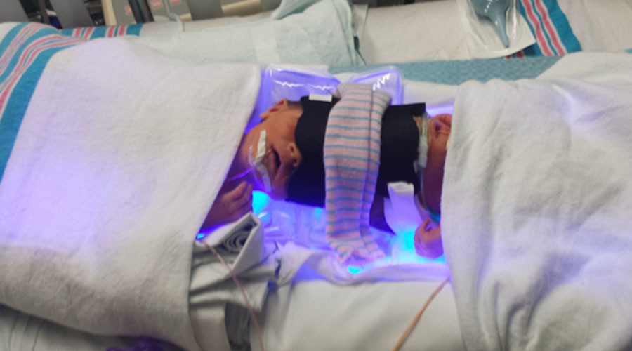 Twins conjoined at the head successfully separated