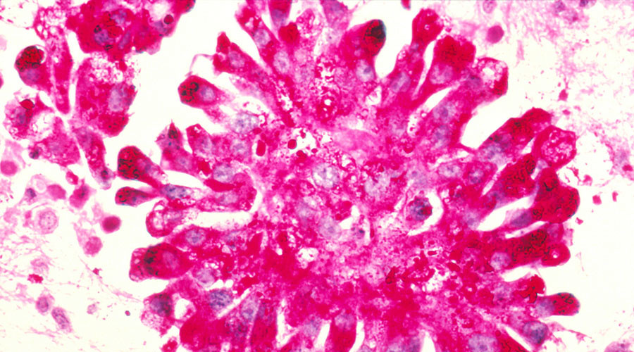 Natural born killers: Common virus can stimulate immune system to destroy cancer cells – study