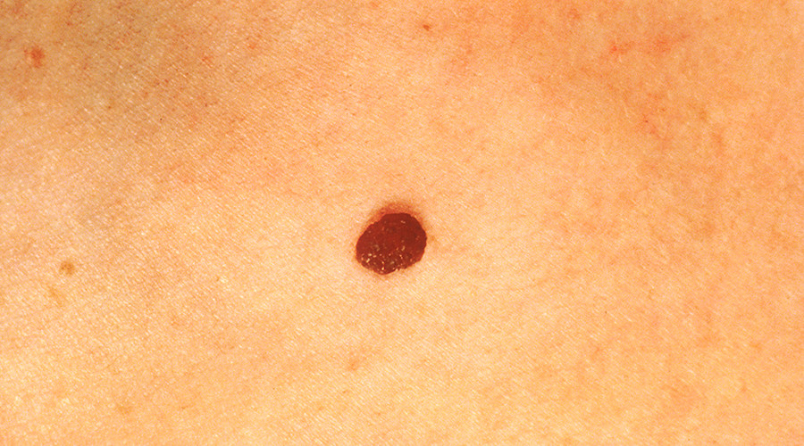 ‘Eureka moment’: AI software programmed to spot skin cancer by checking pics of moles