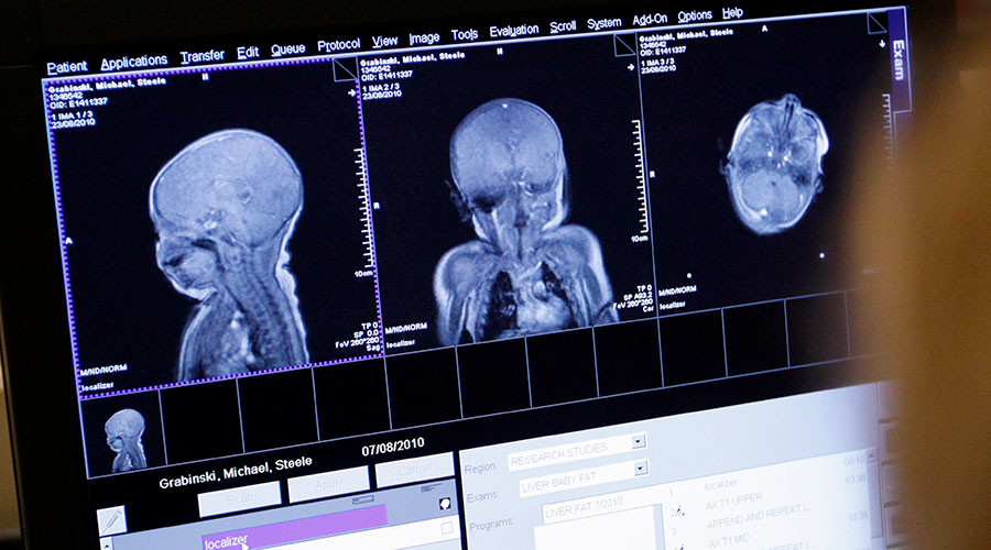 Brain scans may hold key to identifying autism early – study