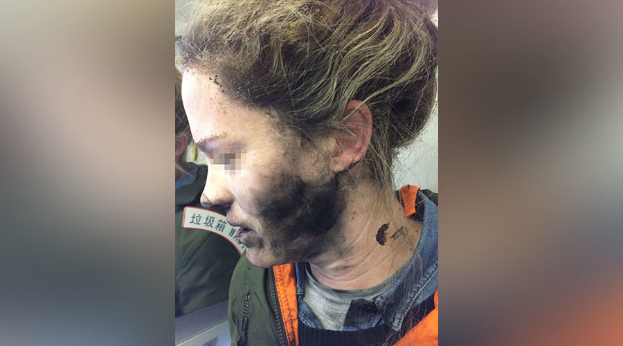 Mid-flight explosion of headphone battery leaves woman with facial burns (PHOTOS)