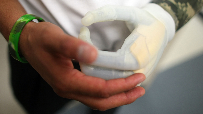 Nerve implants make bionic hand feel almost real