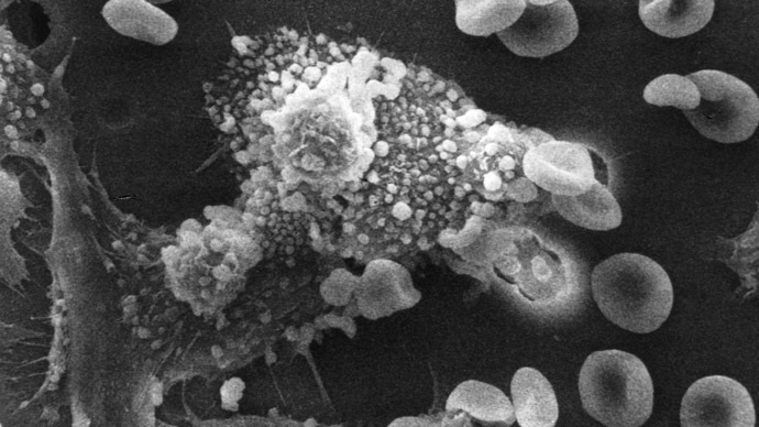 ‘Death from cancer the best’: UK doctor under fire over calls not to ‘waste’ money on tumors cure
