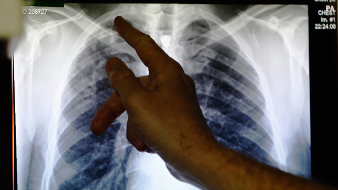 TB or not TB? Britain to eradicate disease ‘of the past’