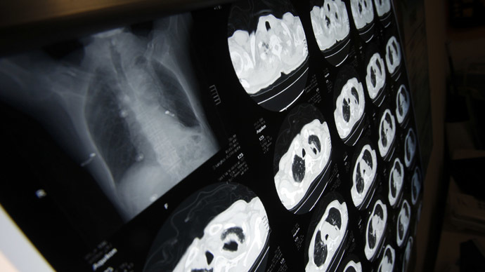 Revolutionary transplant machine keeps lung working for 24 hours outside body