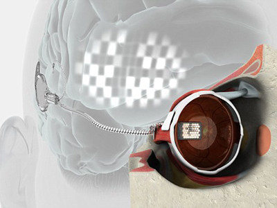 It’s a miracle! World’s first bionic eye gifts blind woman eyesight