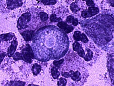 Deadly ‘brain-eating’ microbe outbreak in Pakistan