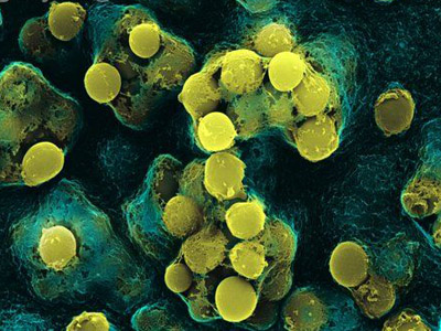 Killer strain: TDR tuberculosis strikes India