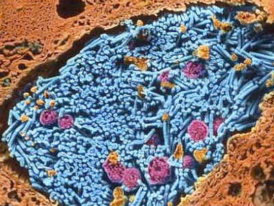 Anthrax drug death sparks fear of Europe-wide pandemic