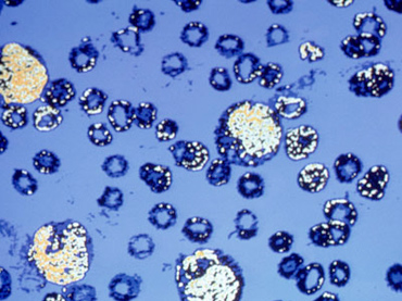 The idiot cycle: What you aren't being told about cancer